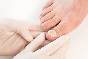 Laser Treatment for Nail Fungus